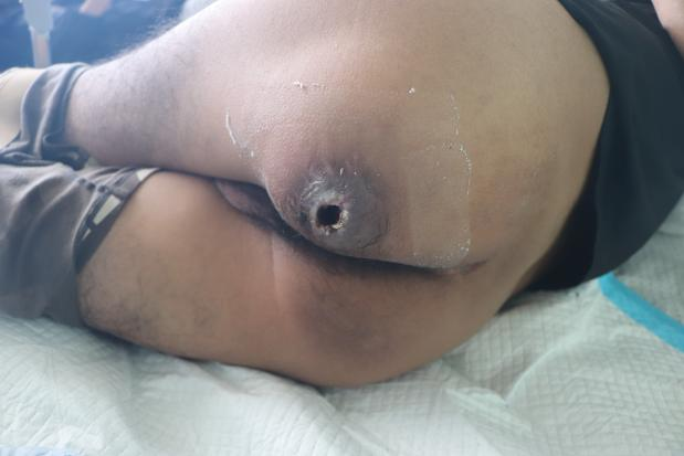 河南省开封市褥疮患者楚某某